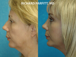 Procedure: Submental (Neck) Liposuction & Facelift Middleton WI plastic surgery submental liposuction female patient
