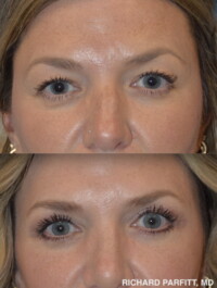 <strong>Procedures: Upper Blepharoplasty for hooding and Lower Blepharoplasty-tightening</strong> Blepharoplasty before and after photo Middleton WI, Dr. Richard Parfitt