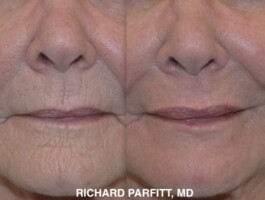 <strong>Procedure:</strong>Dermabrasion - Peri-oral (around the mouth). Deep skin resurfacing to minimize lines around the mouth. Patient age 72. Before and after photo of skin resurfacing treatment for lines around the mouth- Dermabrasion by Dr. Parfitt