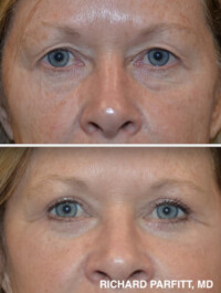 <strong>Procedures: Upper and Lower Blepharoplasty. Pateint age 63. She loves wearing makeup again!</strong> Before and after photo of blue eyed 63 year old patient who had Upper and Lower blepharoplasty, eyelid surgery, done by Dr. Richard Parfitt of Madison WI