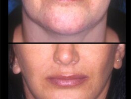 <strong>Procedures: Lip Implant - natural looking volume to upper and lower lip with Alloderm implants</strong> Before and after image of small Upper & Lower Lip implants by Dr. Parfitt