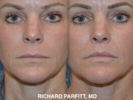<strong>Procedure:</strong>Upper Lip Lift to shorten the distance from the nose to the upper lip and 'turn' out the upper lip to restore volume. This creates a more youthful look. Before and after photo of an Upper Lip lift procedure done by Dr. Parfitt