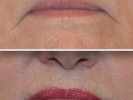 <strong>Procedures: </strong> Commissure lift before and after results showing improvement in downturned corners of the mouth by Dr. Richard Parfitt in Middleton, Wisconsin. Commissure lift before and after close-up photos showing elevated mouth corners and improved lip corner contours.
