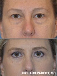 <strong>Procedures: </strong>Upper and lower blepharoplasty before and after results showing reduced under-eye puffiness and refreshed eyelid contours by Dr. Richard Parfitt in Middleton, WI. Upper and lower blepharoplasty before and after close-up photos showing smoother under-eye contours and a refreshed appearance around the eyes.