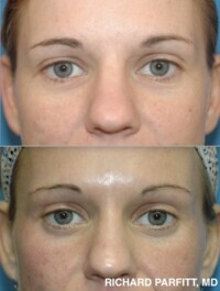 <strong>Procedures: </strong>Upper and lower eyelid tightening before and after photographs showing subtle eyelid rejuvenation by Dr. Richard Parfitt in Middleton, Wisconsin. Upper and lower eyelid tightening before and after close-up photos showing changes in eyelid contours and the appearance of the upper and lower eyelids.